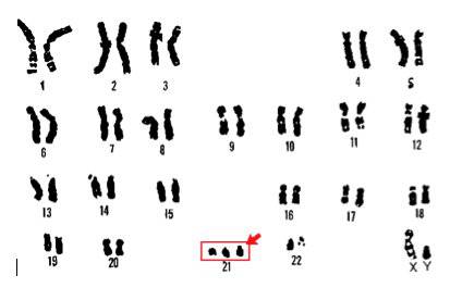 trisomy 21